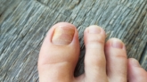 Onychomykose (Nagelpilz)