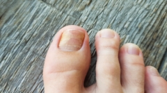 Onychomykose (Nagelpilz)
