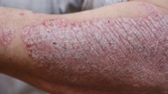 Psoriasis (Schuppenflechte)2