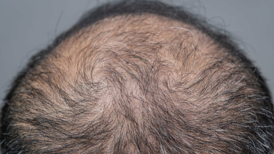 Haarausfall: Ursachen, Behandlungsmöglichkeiten und Tipps zur Vorbeugung