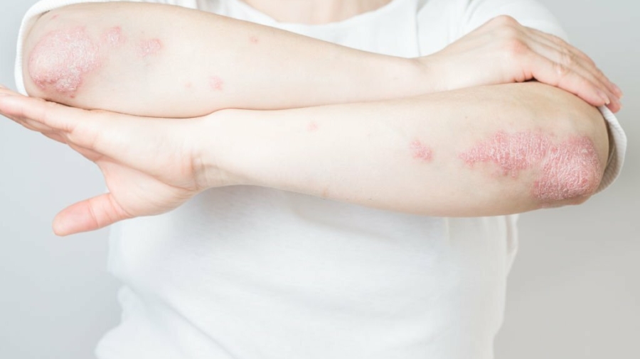 Psoriasis-Behandlung: Effektive Methoden, um Schuppenflechte zu lindern