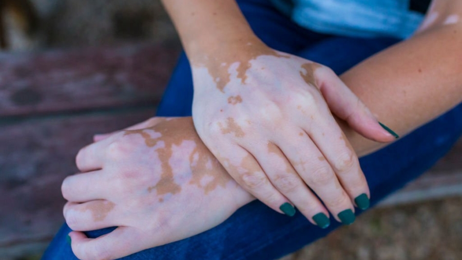 Vitiligo-Behandlung: Tipps und Tricks zur Wiederherstellung der natürlichen Hautfarbe