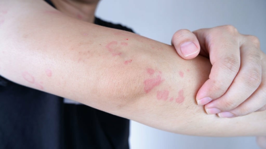 Allergische Kontaktdermatitis: Ursachen, Symptome und wirksame Behandlung