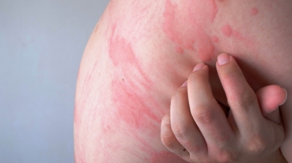 Dermatophyteninfektionen Diagnose- und Behandlungsstrategien (1)