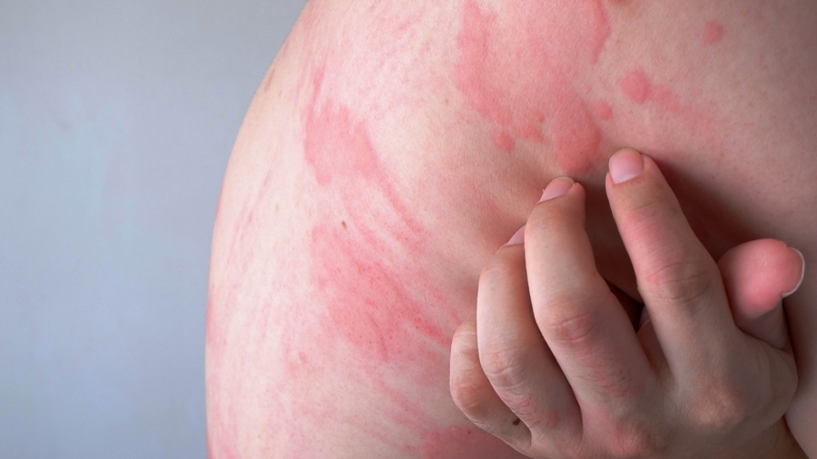 Dermatophyteninfektionen Diagnose- und Behandlungsstrategien (1)