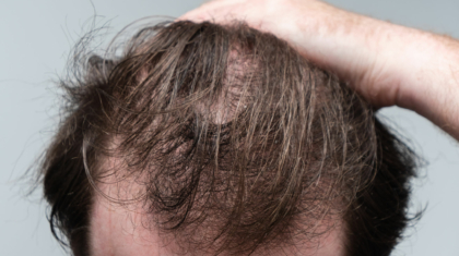 Haarausfall: Eine Bewertung aus dermatologischer Perspektive