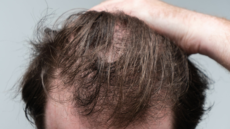 Haarausfall: Eine Bewertung aus dermatologischer Perspektive