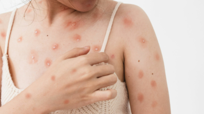 Hautallergien und moderne Behandlungsansätze: Aktualisierung der Dermatologie