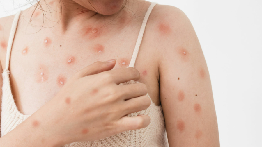 Hautallergien und moderne Behandlungsansätze: Aktualisierung der Dermatologie